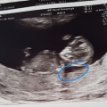 Tijdens een echo blijkt de baby een verdikte nekplooi te hebben, een vruchtwaterpunctie volgt